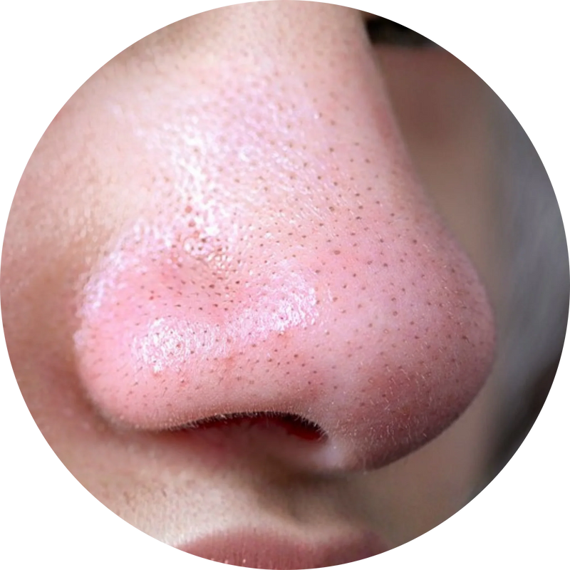 Elimina poros y puntos negros