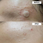 NINELESS A-Control 10% Azelaic Acid Serum 30ml